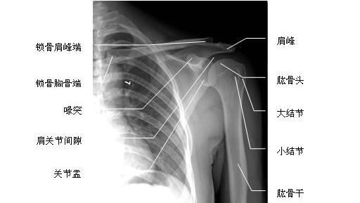 肩关节正位-x线图