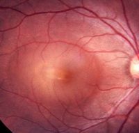 糖尿病性视网膜病变的症状