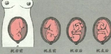 胎方位讲解示意图