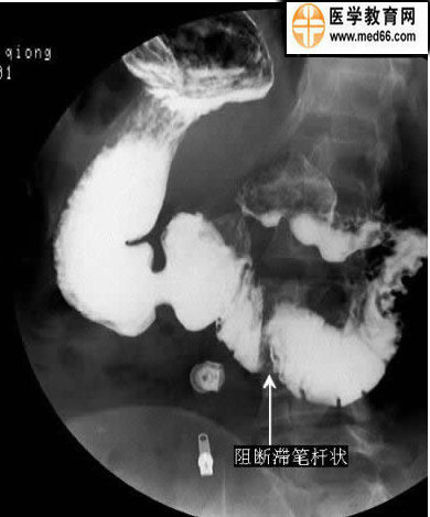 轉發分享: 分享到: 十二指腸球部潰瘍(圖示) 嗜鉻