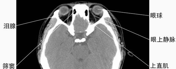 眼眶横断面ct图片