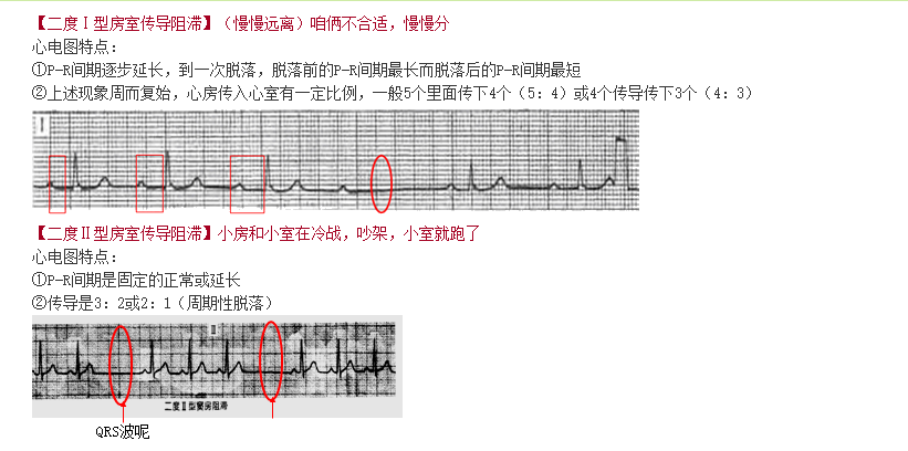 期前收缩心电图PPT图片