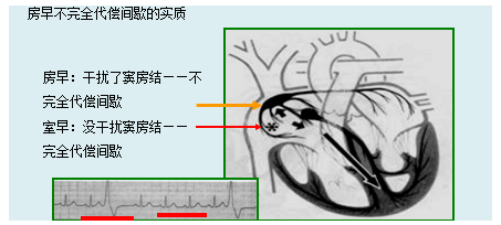 房性期前收缩的心电图特点