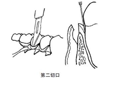 翻瓣术