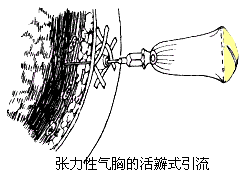 张力性气胸活瓣图片