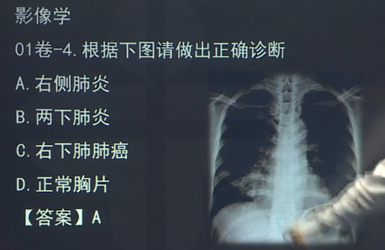 临床执业医师实践技能考试第一站影像题——右侧肺炎的胸片
