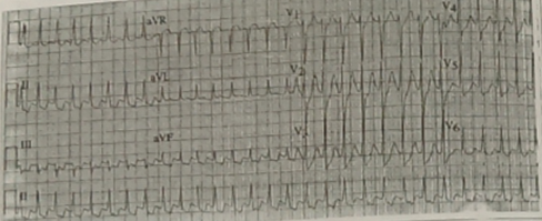 心律失常 心律失常