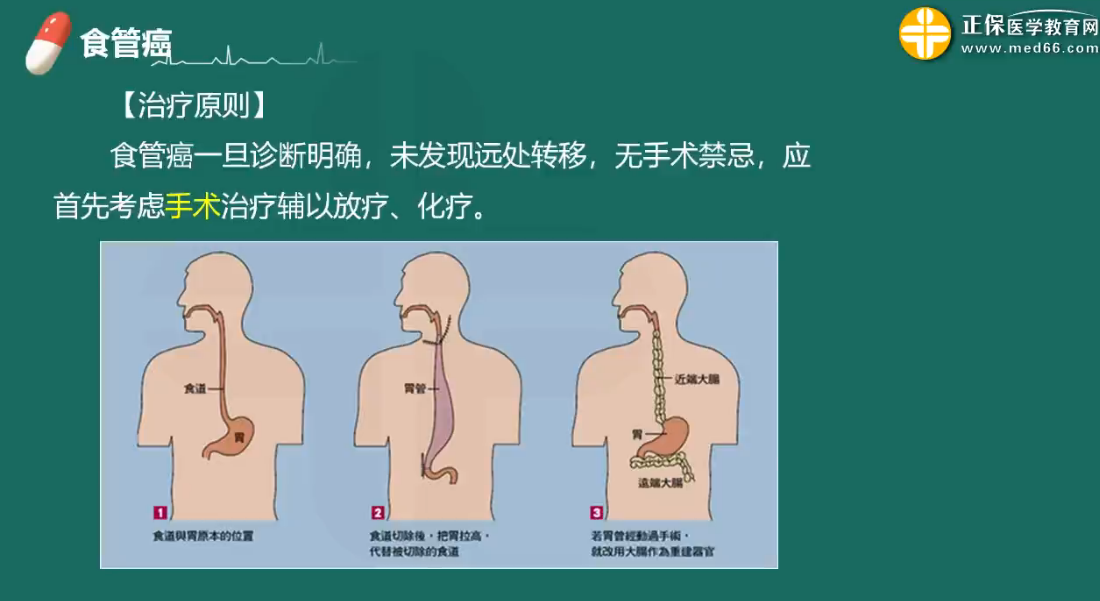 术后3～4天进行胃肠减压b严密观察c经常挤压胃管以免阻塞d