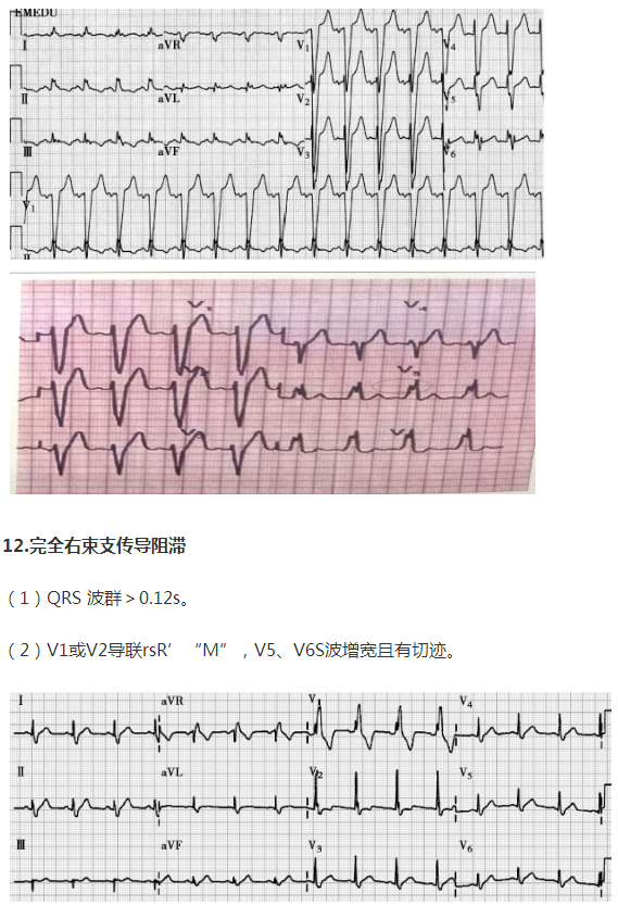 完全右束支传导阻滞