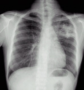 左上浸润型肺结核