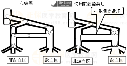 心绞痛