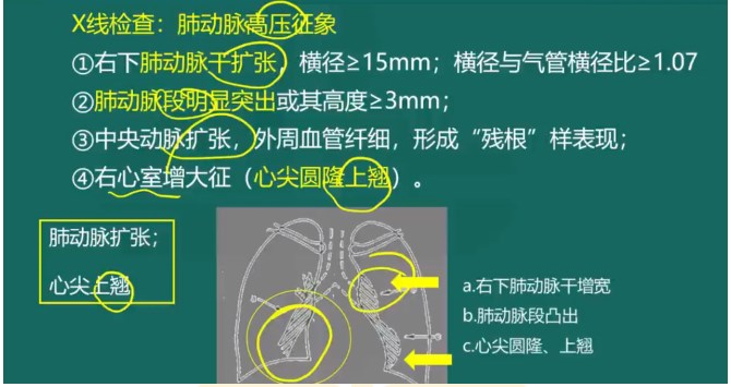 慢性肺源性心脏病X线检查