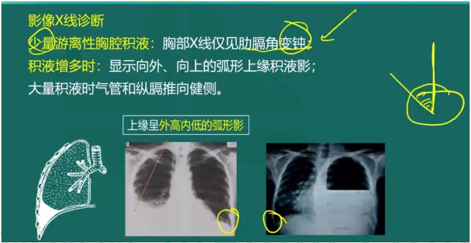 胸腔积液影像X线诊断