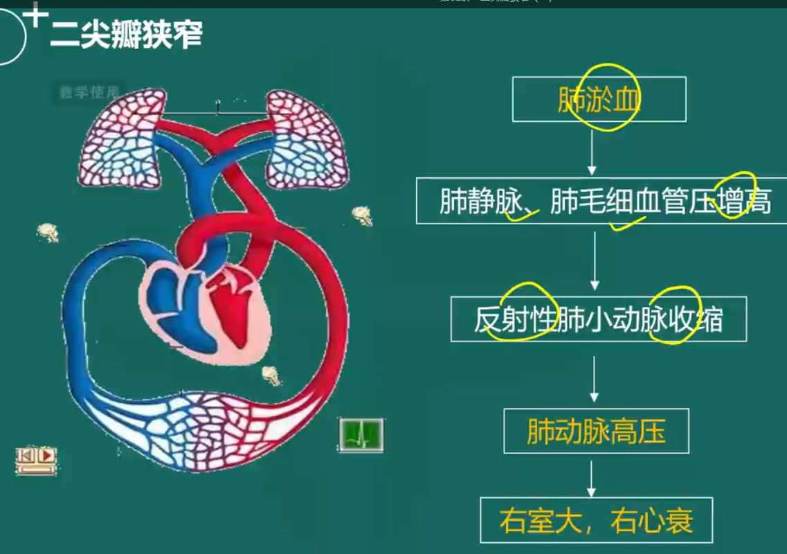 【2023临床助理医师专业解读】二尖瓣狭窄